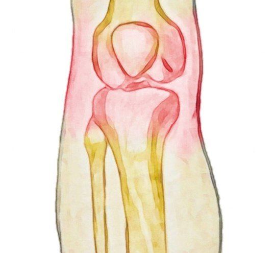 Osteoarthritis