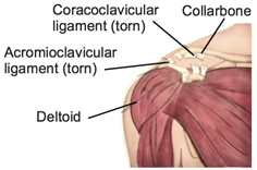 AC Joint Sprains and Injury