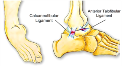 Ankle Sprains