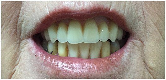 After senior teeth | Ringwood, VIC | Abstract Arch Denture Clinic