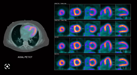 Cardiac PET/CT — Miami, Fl — CIRA