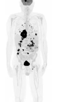 Oncology PET/CT — Miami, Fl — CIRA