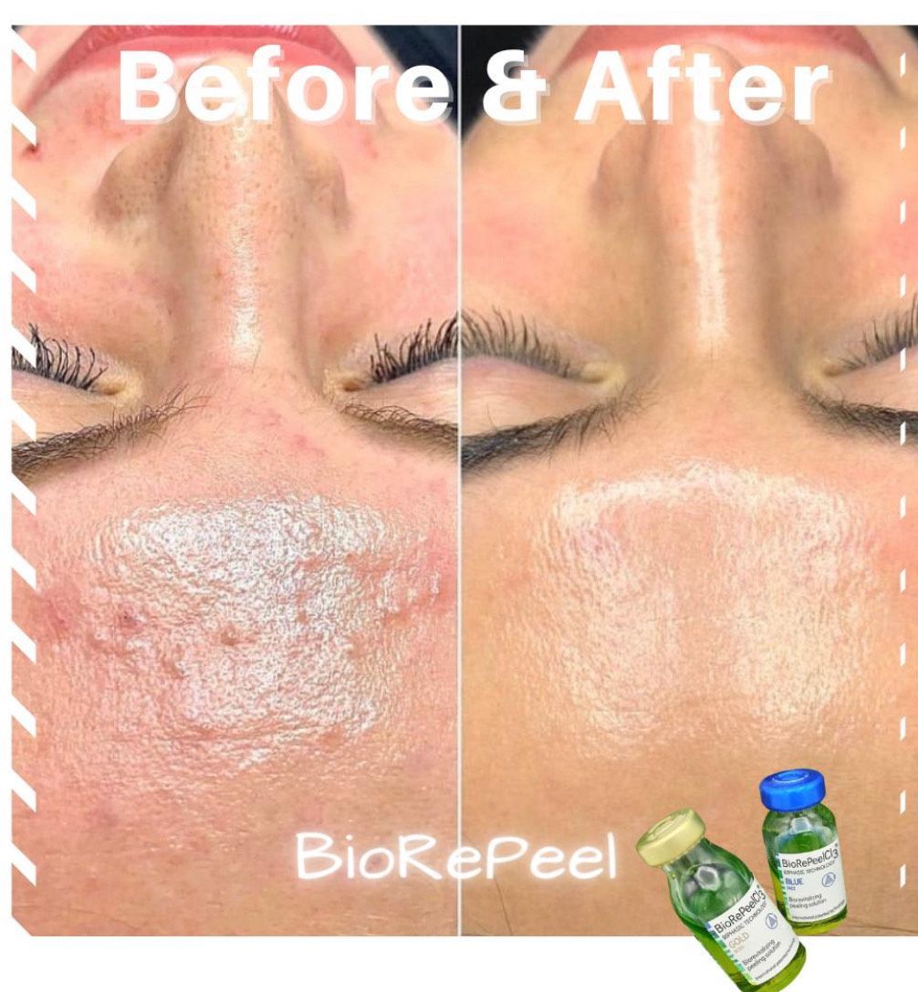 A woman 's face before and after a biorepeel treatment