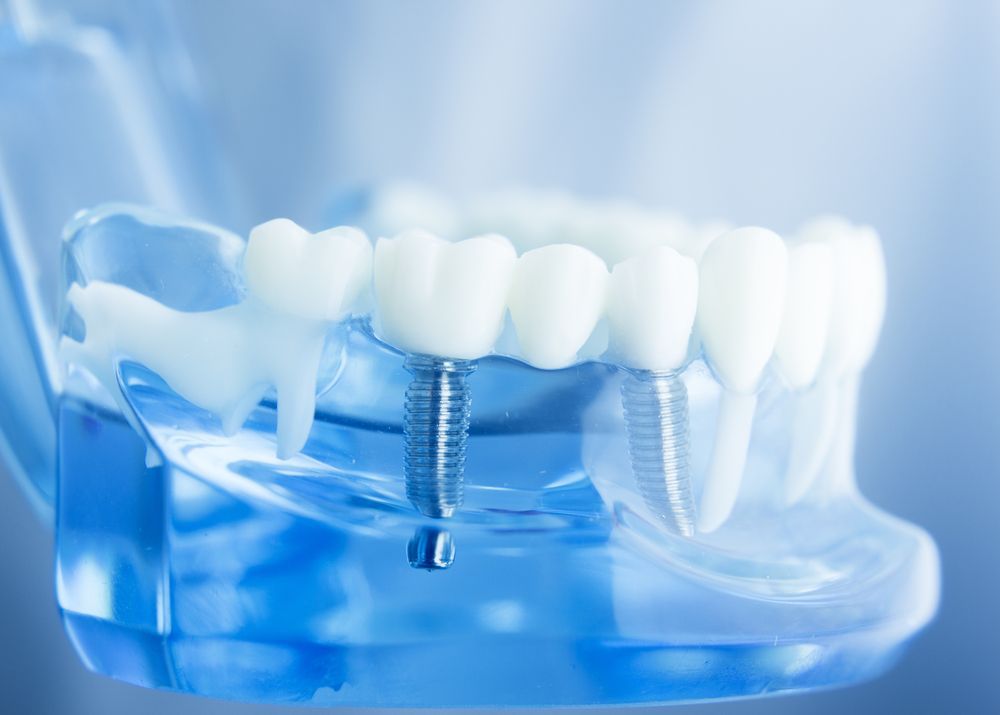 A close up of a model of teeth with dental implants.