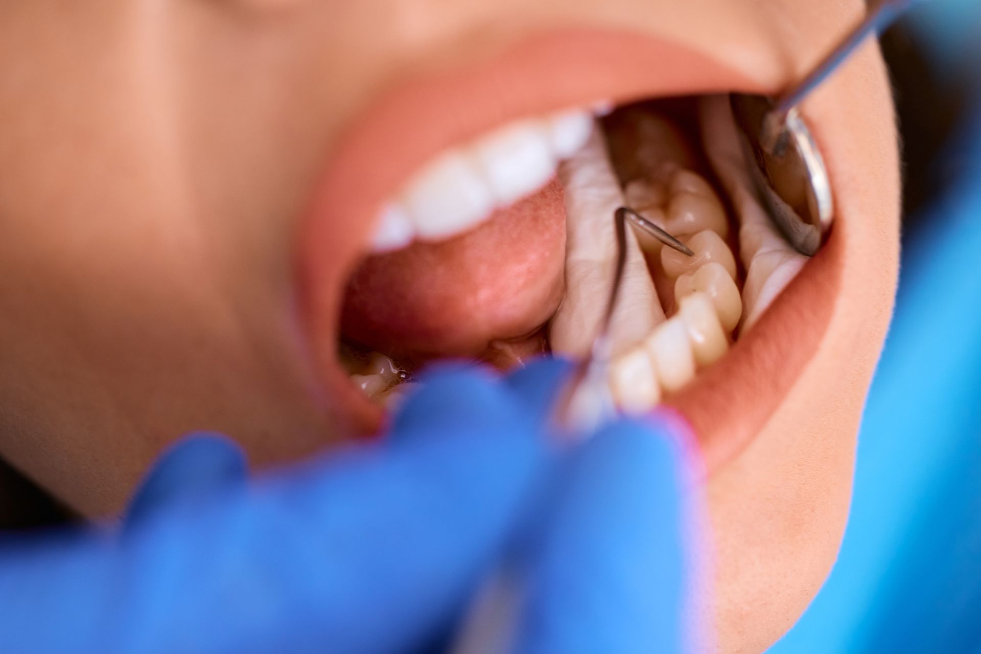 Close-up of a dentist examining a patient's back tooth using dental instruments during a check-up.