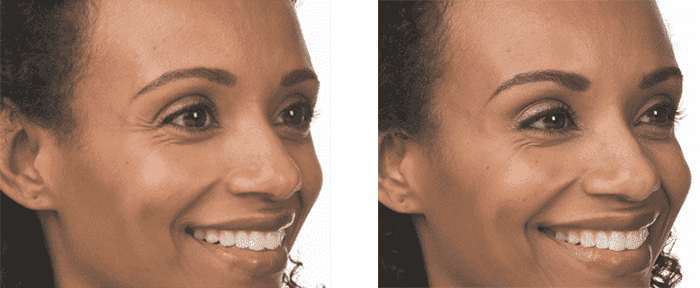 Side-by-side comparison of a woman's face before and after a cosmetic procedure, with visible reduction of wrinkles.