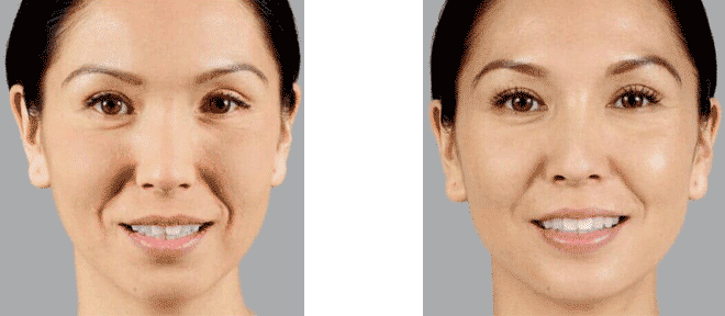 Side-by-side comparison of a woman's face before and after a cosmetic procedure, showing a more youthful appearance.