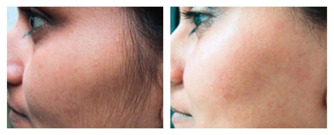 Side-by-side comparison of a woman's face before and after hair removal treatment.