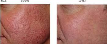 Comparison of a face before and after a skin treatment