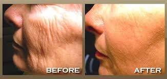 Side-by-side comparison: face with wrinkles (before) and smoother skin (after) cosmetic procedure.