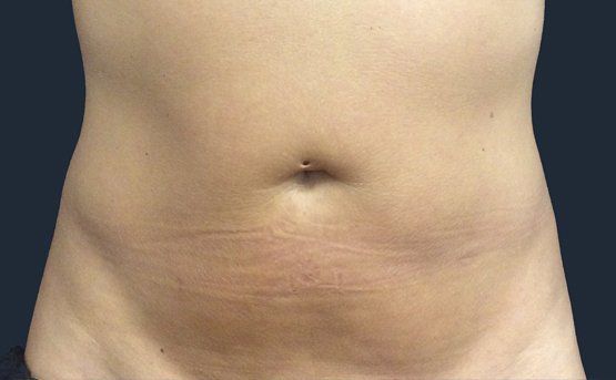 Close-up of a person's bare abdomen, showing the navel and faint horizontal lines. Neutral skin tone.