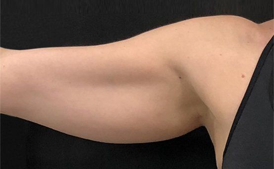 A person's arm, light skin tone, viewed against a black background. Arm slightly bent at the elbow.