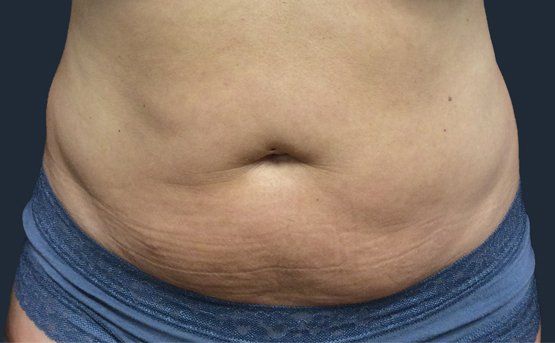 Abdomen with visible stretch marks, navel, and blue underwear against a dark background.