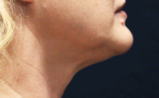 Profile view of a person's neck and chin with prominent double chin.