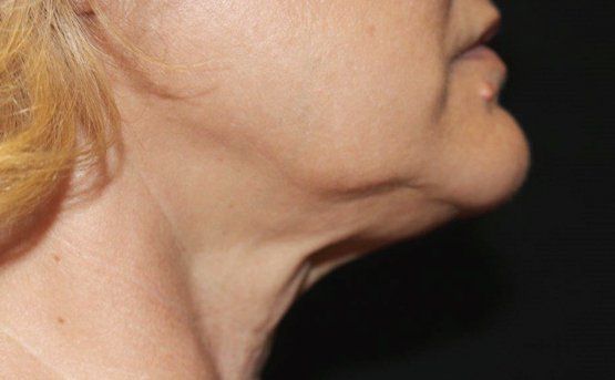 Profile view of a person with sagging neck skin and jowls against a dark background.