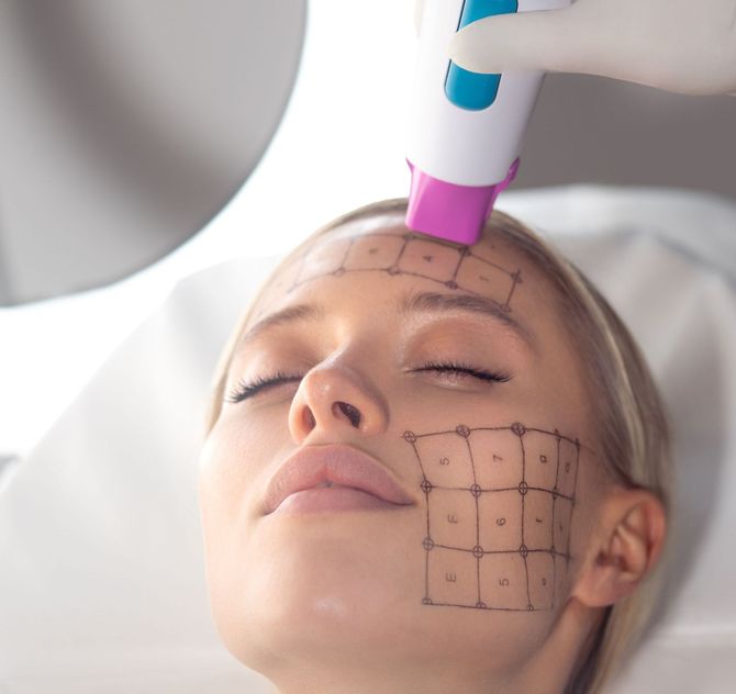 Thermage FLX Gesicht