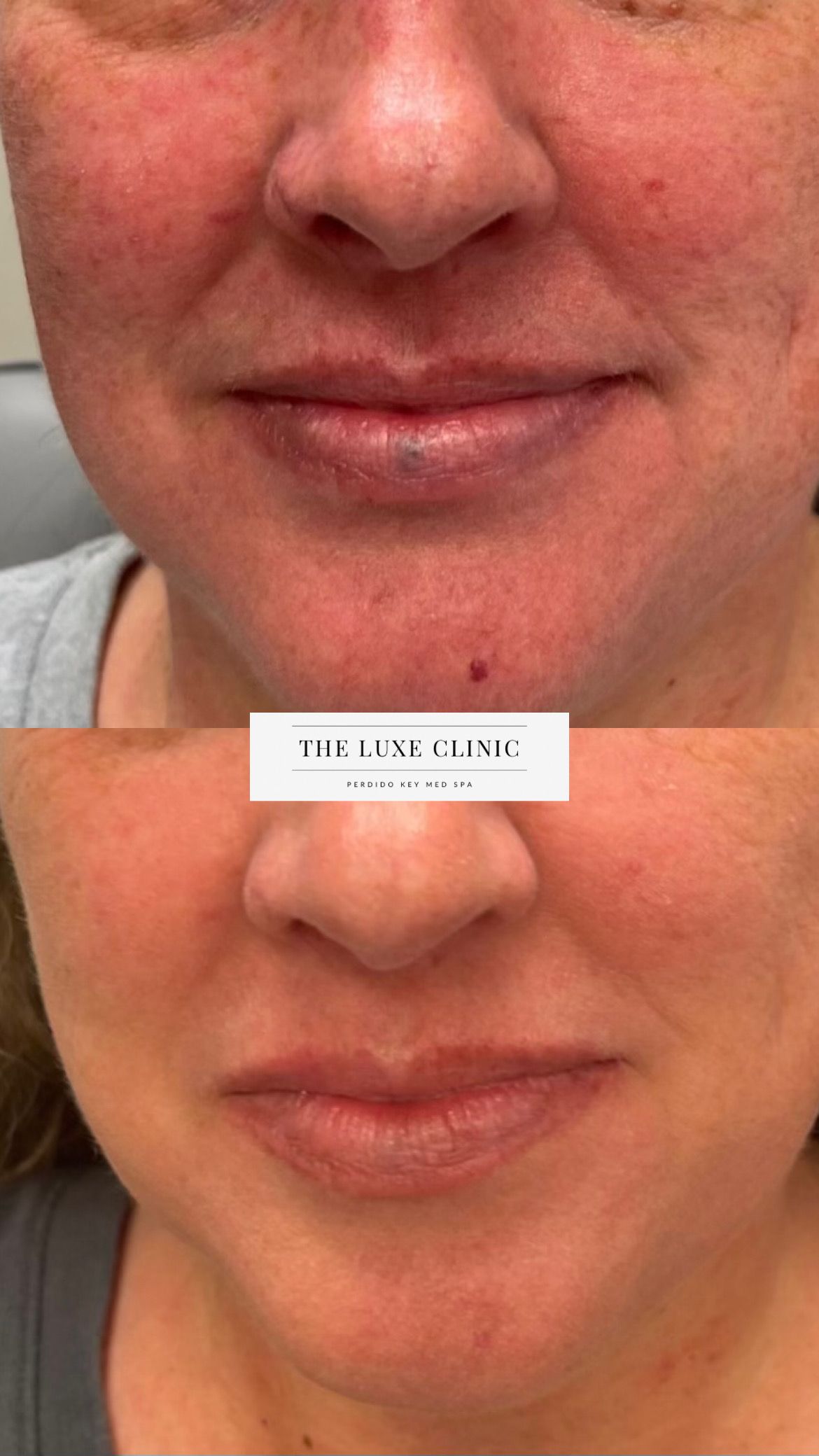 A before and after photo of a woman 's face with redness.
