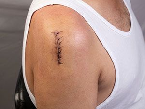 Close-up of a man's shoulder with a recent surgical scar and stitches, wearing a white tank top.