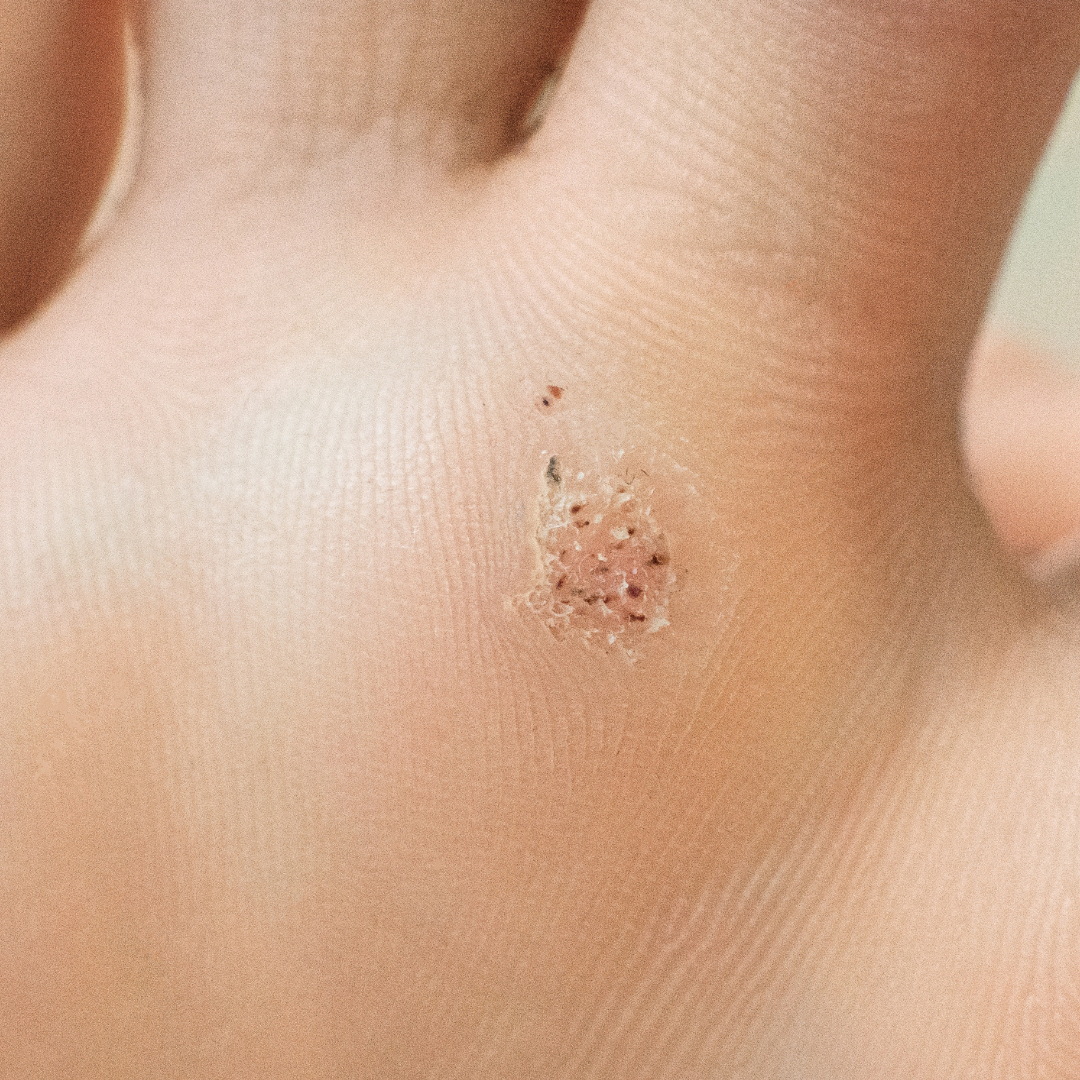 Picture of a verruca infection growing on the skin of a foot.