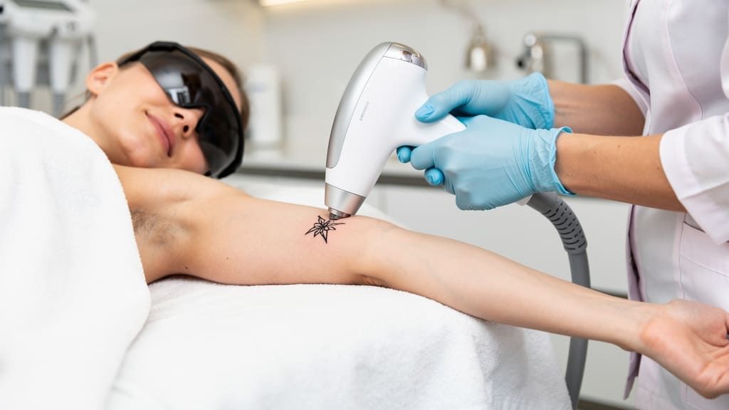 Tattoo Removal Tampa