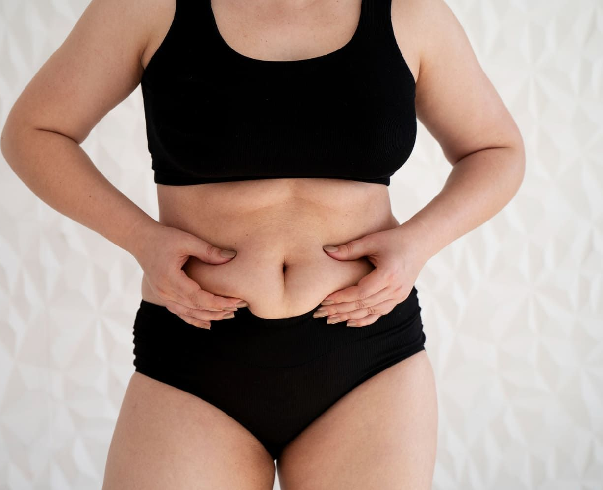 treatment for cellulite Tampa
