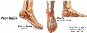 Plantar Fascia - Lombard, IL - Zimmerman Scott A DPM