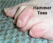 Patient’s hammer toe for neuropathy treatment in Lombard, IL