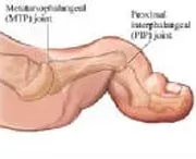 Metatarsophalangeal Joints - Lombard, IL - Zimmerman Scott A DPM