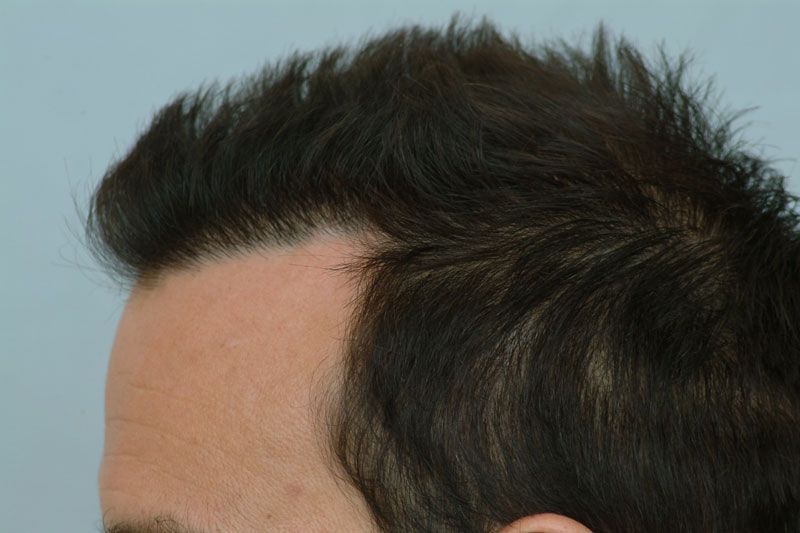 Forhair Hair Transplant Results Patient DRS