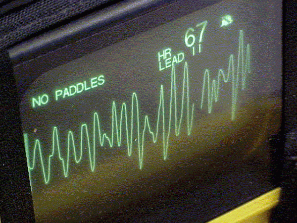 Synchronized cardioversion and transcutaneous pacing, AHA ACLS classes, Cardiac Edge Central Florida Defibrillation and synchronized cardioversion training during an AHA ACLS class, electrical therapy, Cardiac Edge Central Florida