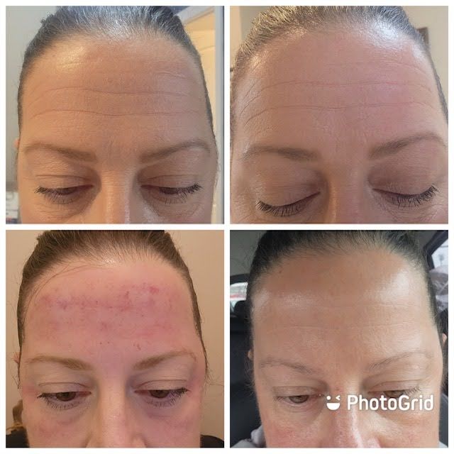 Person with forehead before and after application of microneedling treatment with PRP