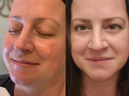 before and after microneedling
