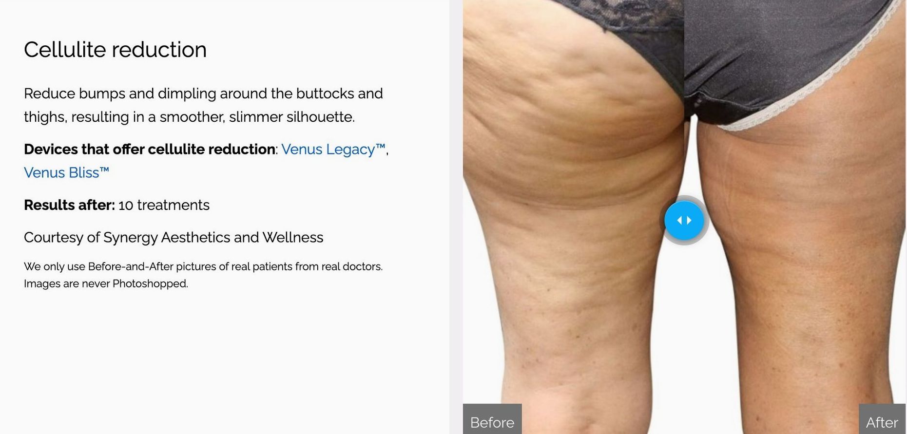 The Venus Body Shop Cellulite Reduction Body Contouring Venus Legacy results example courtesy of the Younger Body Medspa