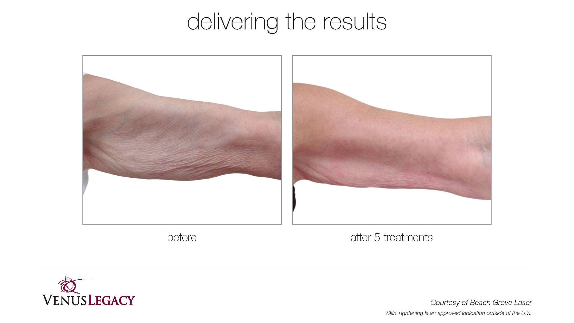 Client Forms for Fat Treatments | The Venus Body Shop | Huntsville, Decatur, Madison, AL