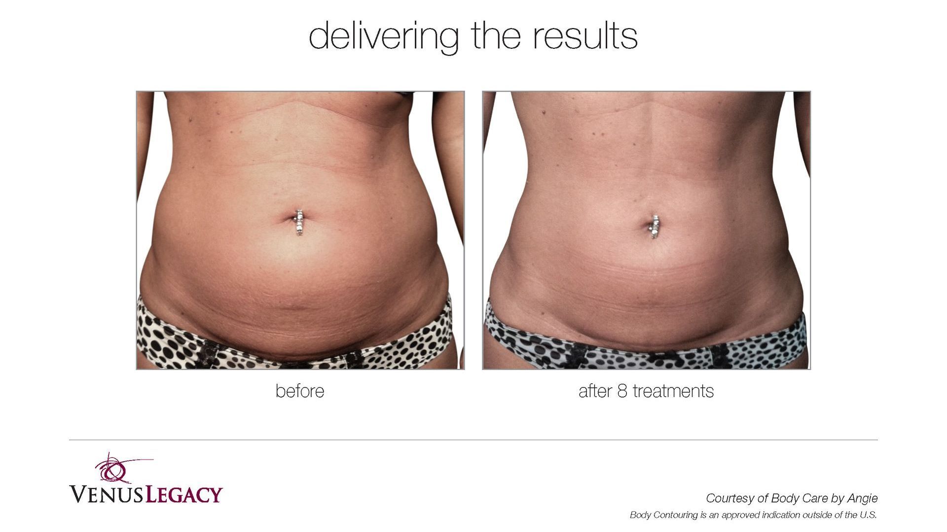 A before and after picture of a woman 's stomach.