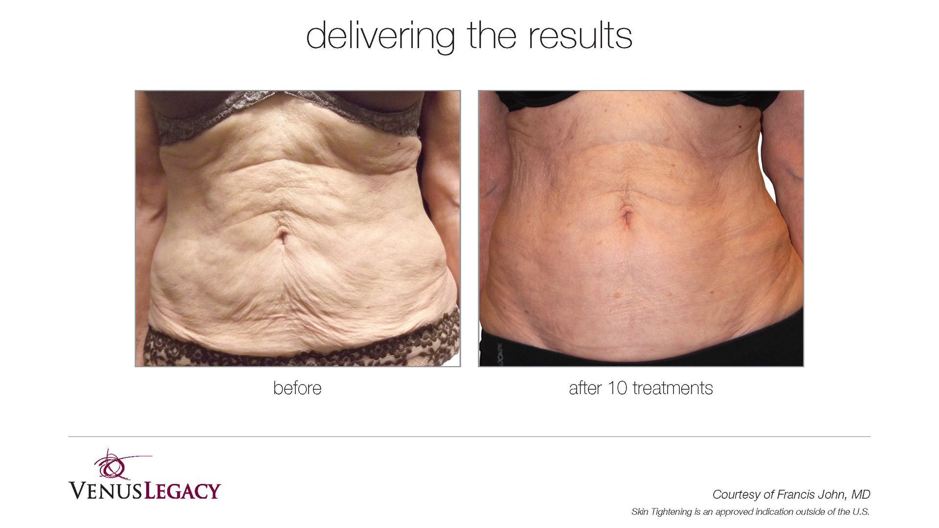 A before and after picture of a woman 's stomach.