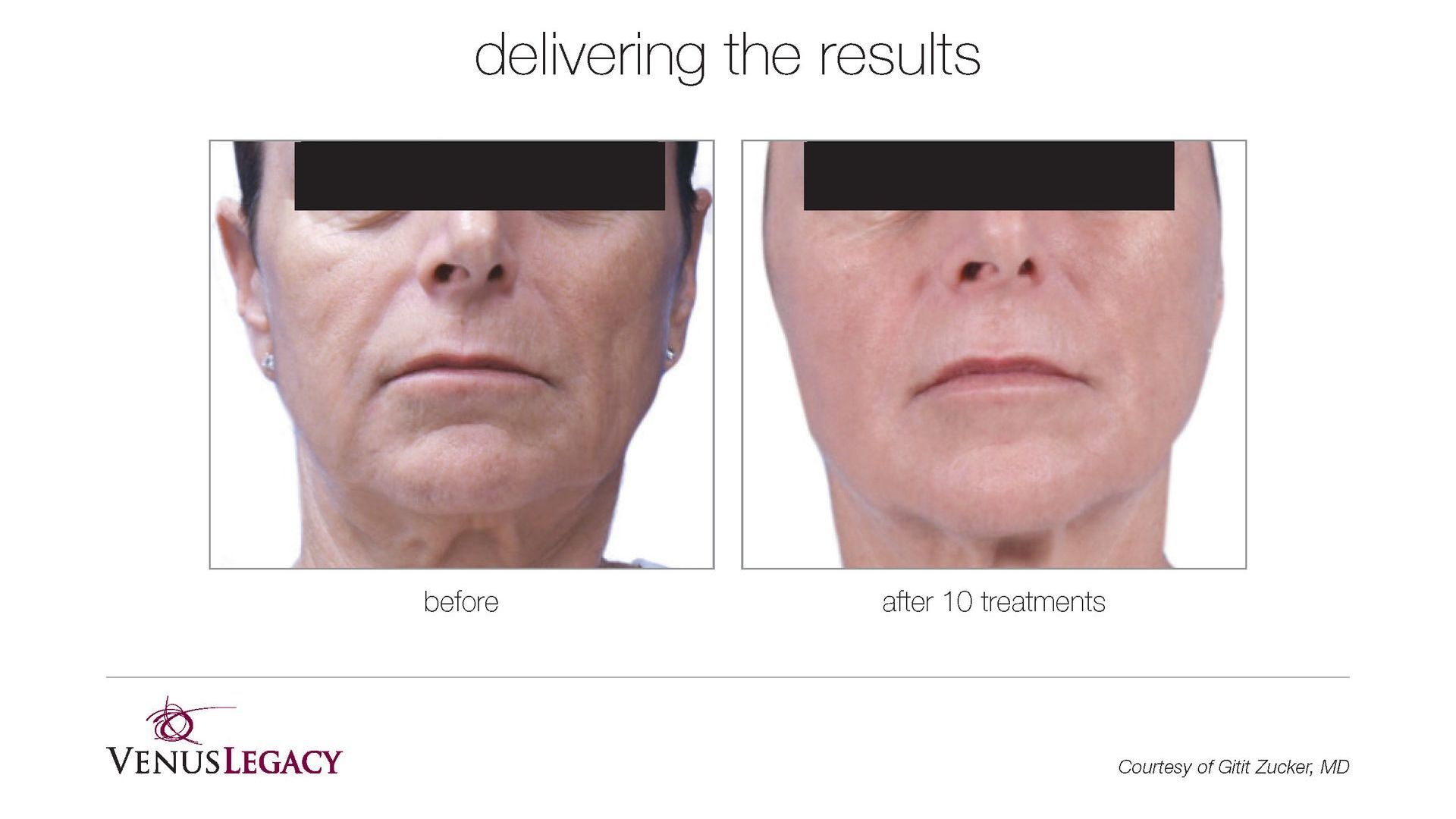 A before and after picture of a woman 's face.