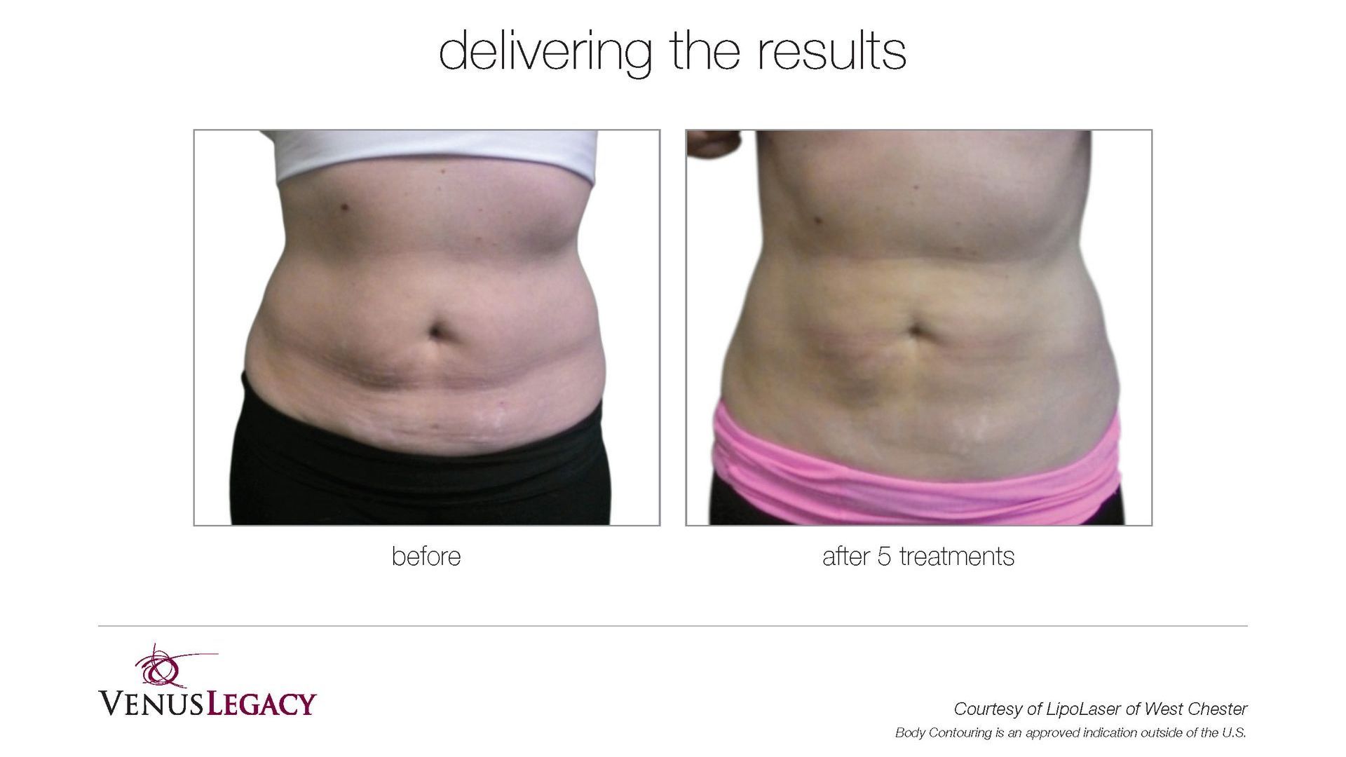 A before and after picture of a woman 's stomach.