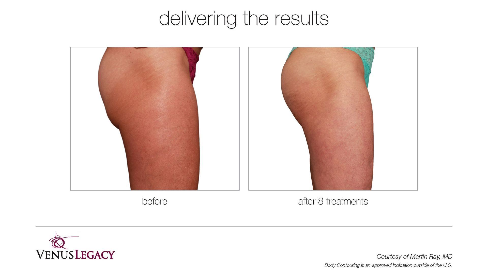 Side-by-side before-and-after photos of a leg, showing reduced redness and swelling after treatment
