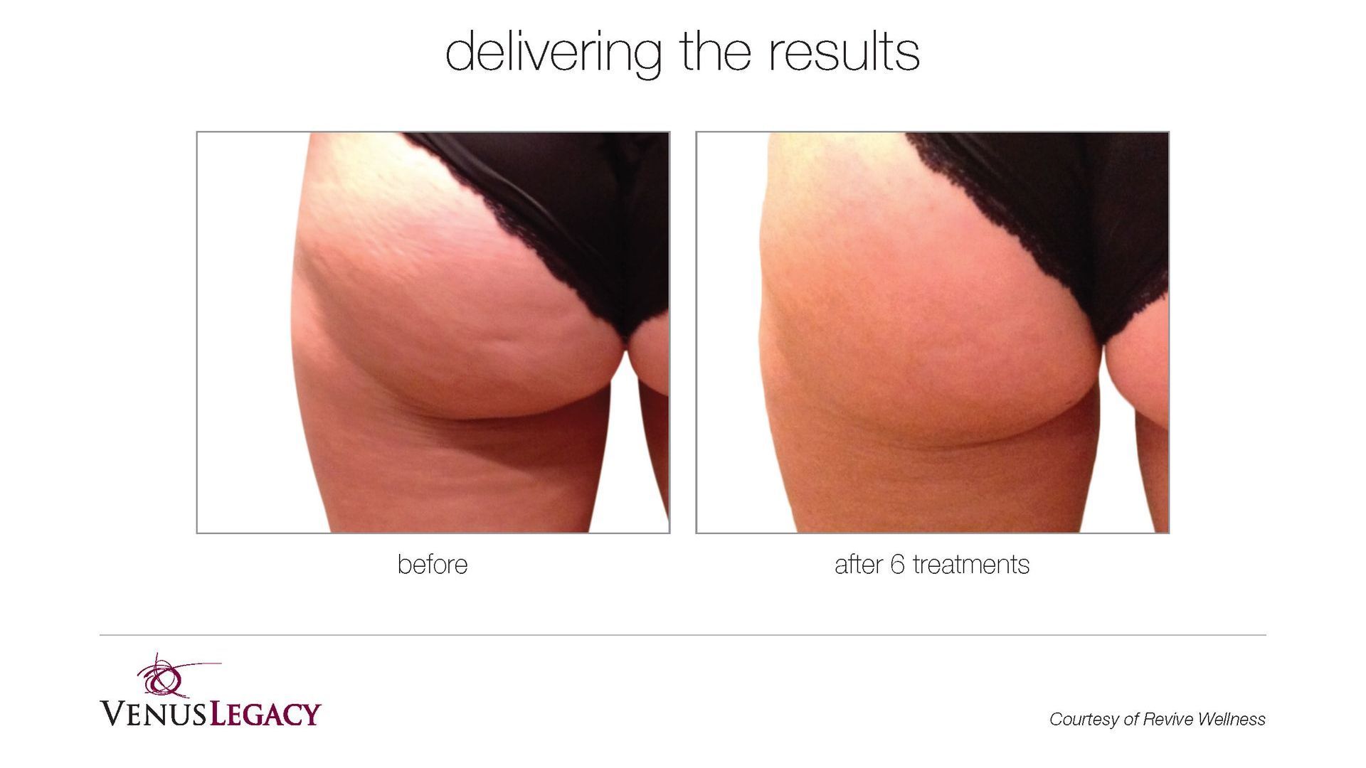 Side-by-side before-and-after photos of a buttock lift, showing a smoother contour.