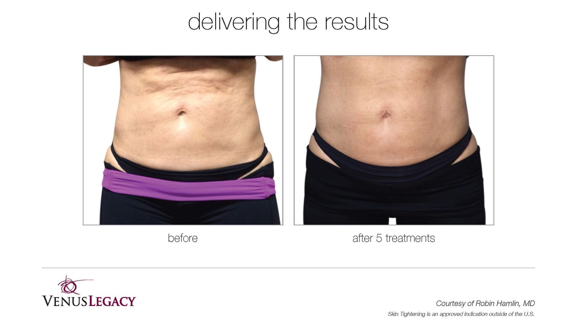 A before and after picture of a woman 's stomach.