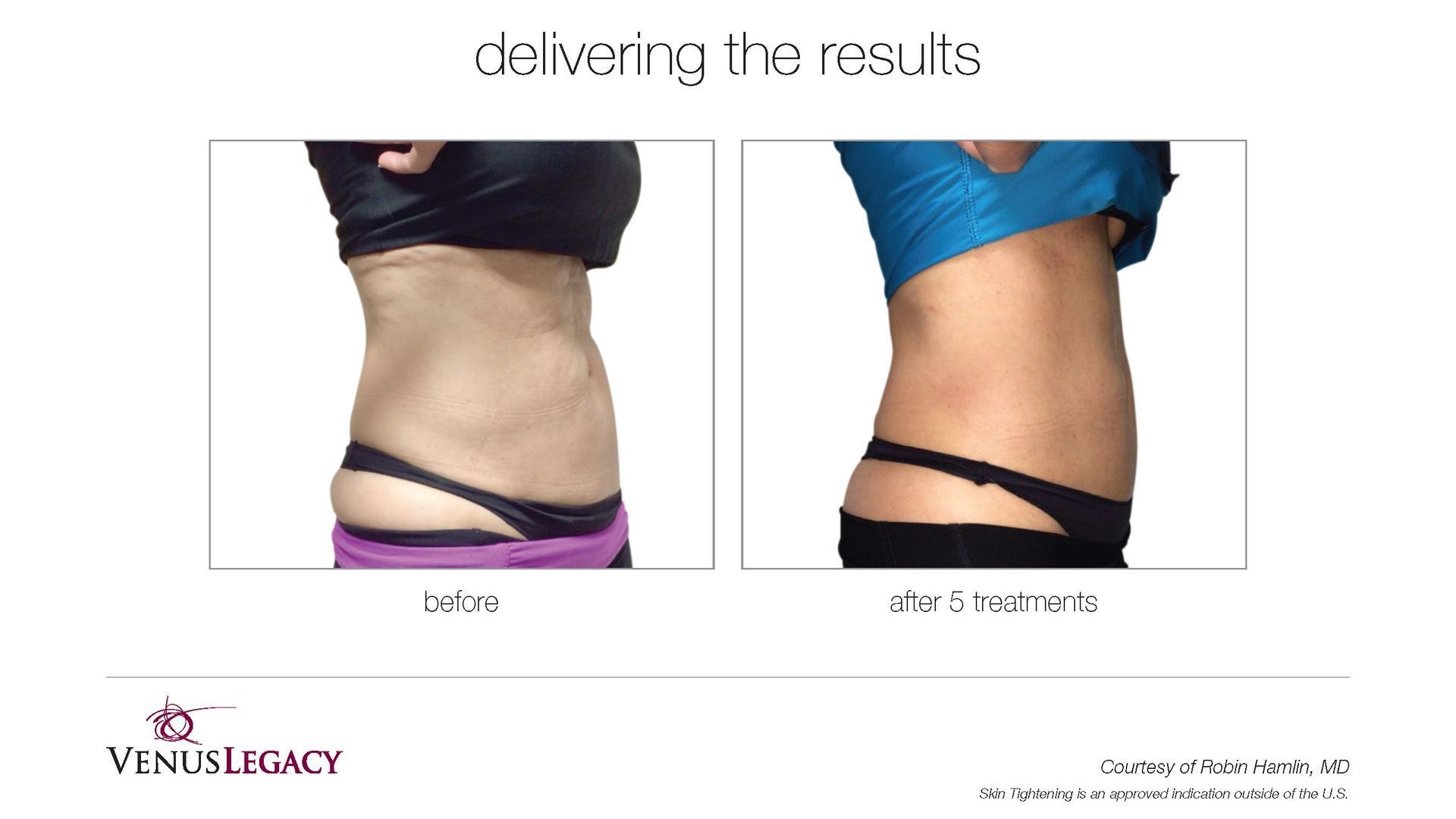 A before and after picture of a woman 's stomach.