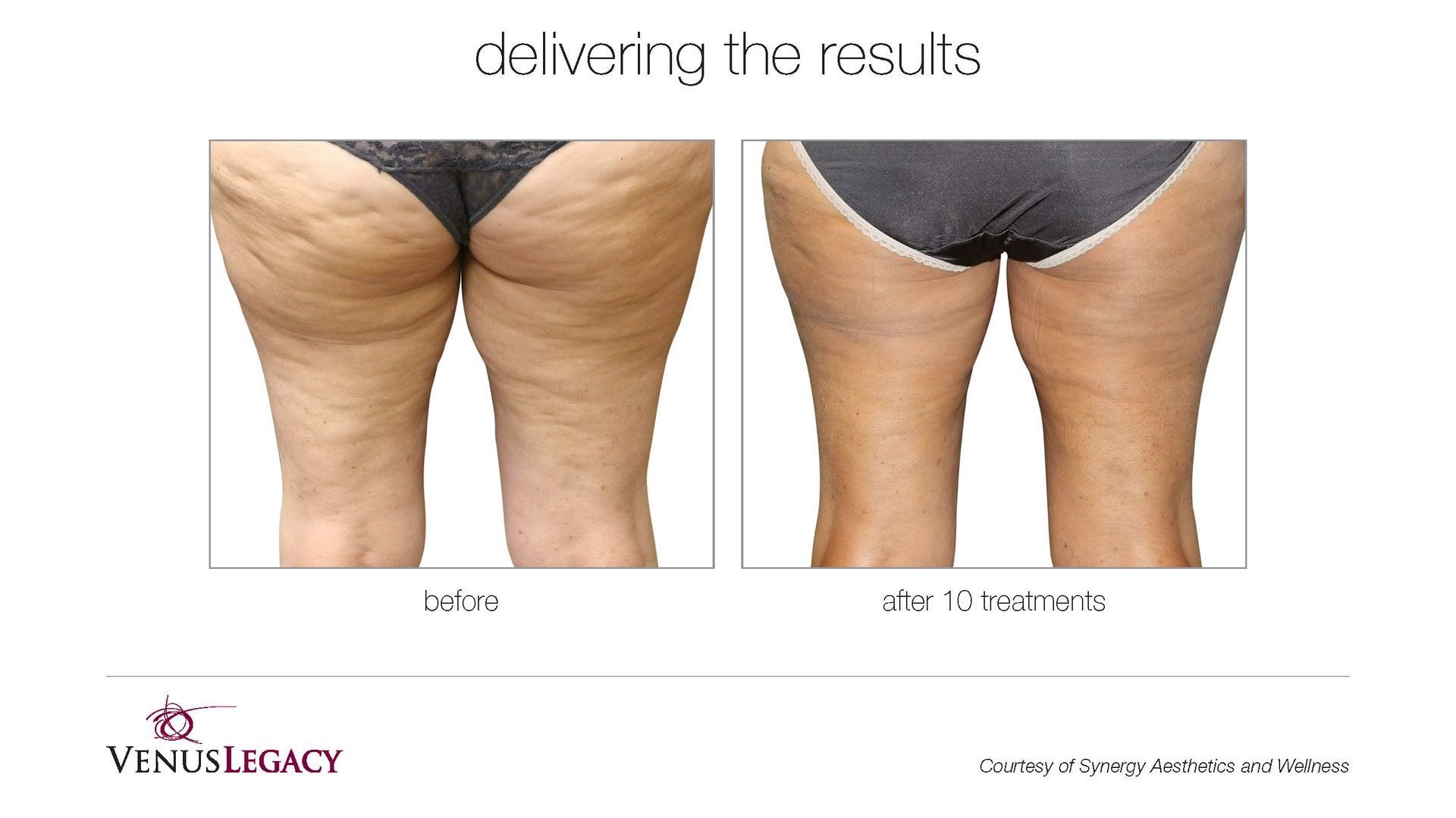 A before and after picture of a woman 's thighs with and without cellulite.