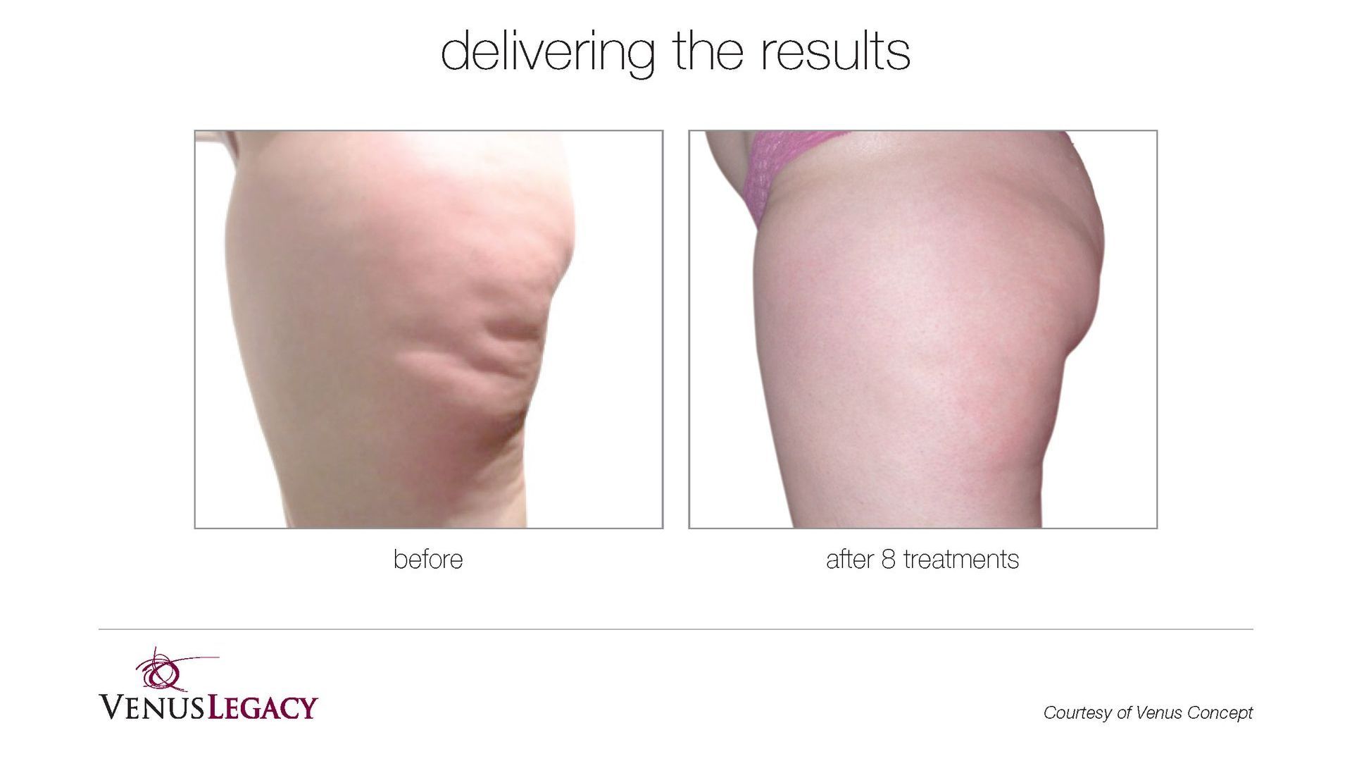 A before and after picture of a woman 's thighs showing the results of a treatment.