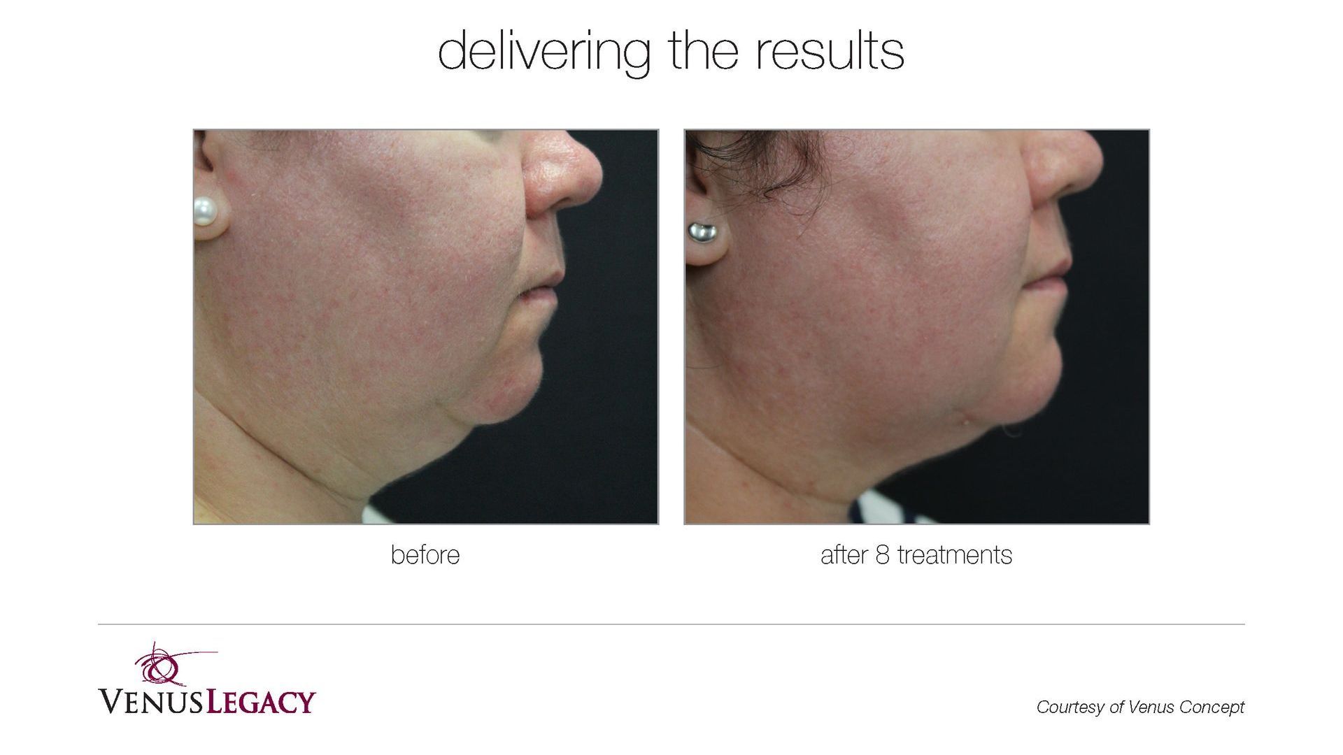 A before and after photo of a woman 's neck and face.