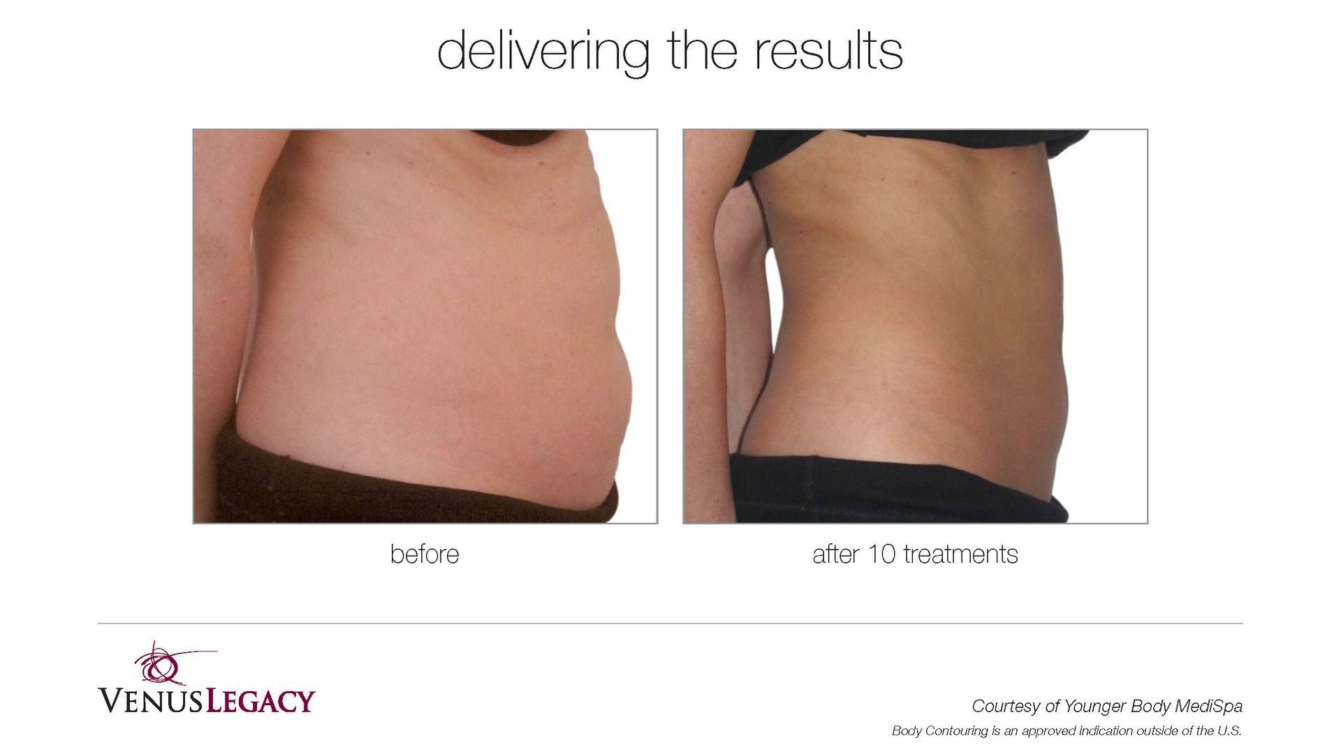 A before and after picture of a woman 's stomach