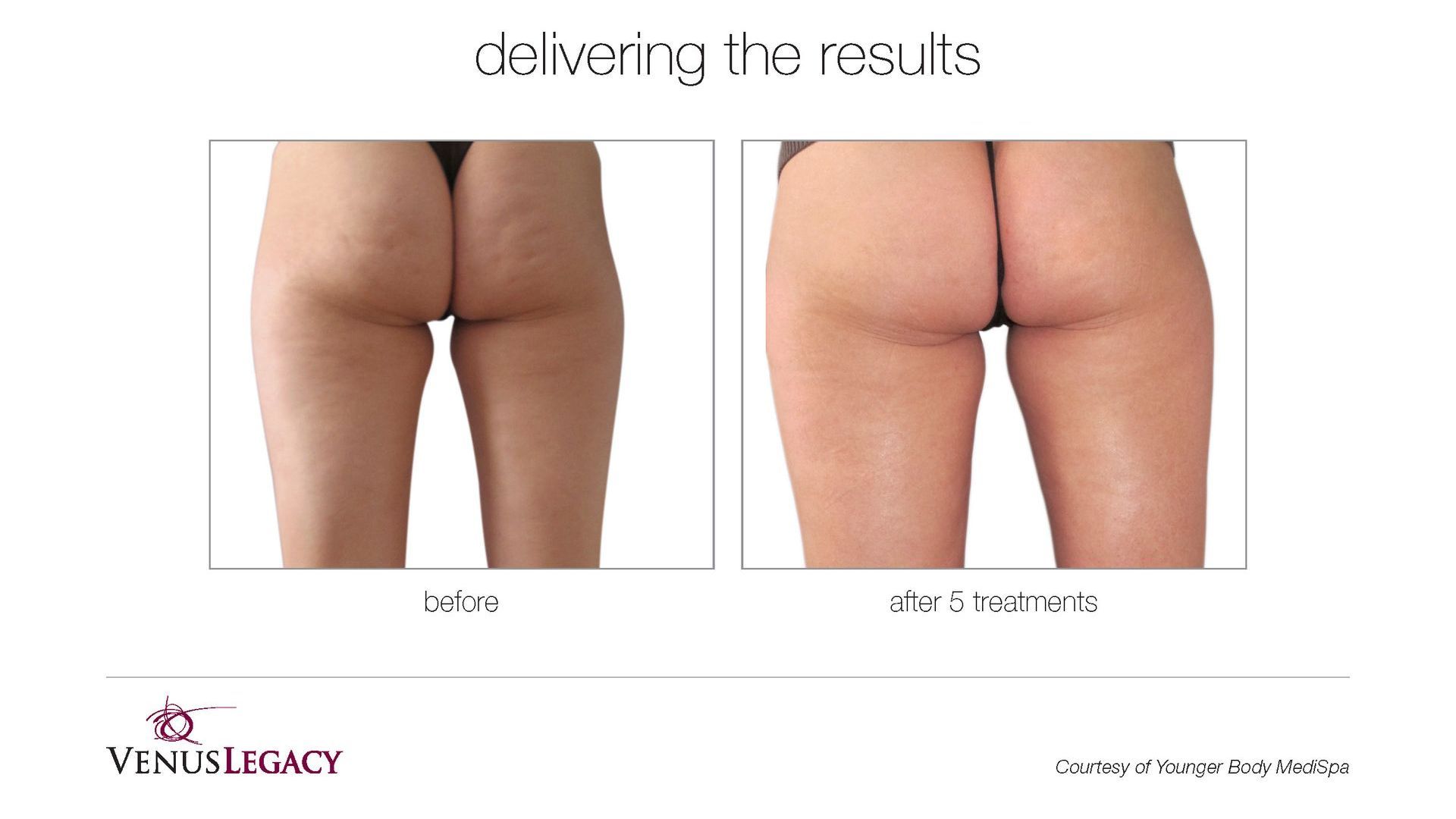 Before-and-after buttock photos labeled “delivering the results,” showing a smoother, lifted appearance