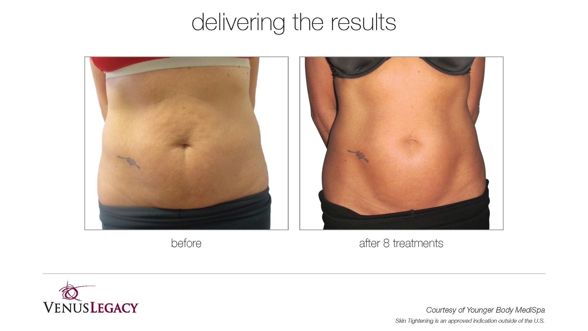 A before and after picture of a woman 's stomach.