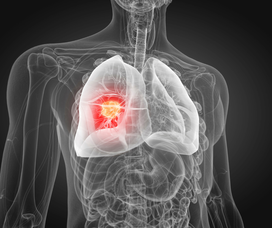 Lung Cancer | Service Page | LA Cancer Network