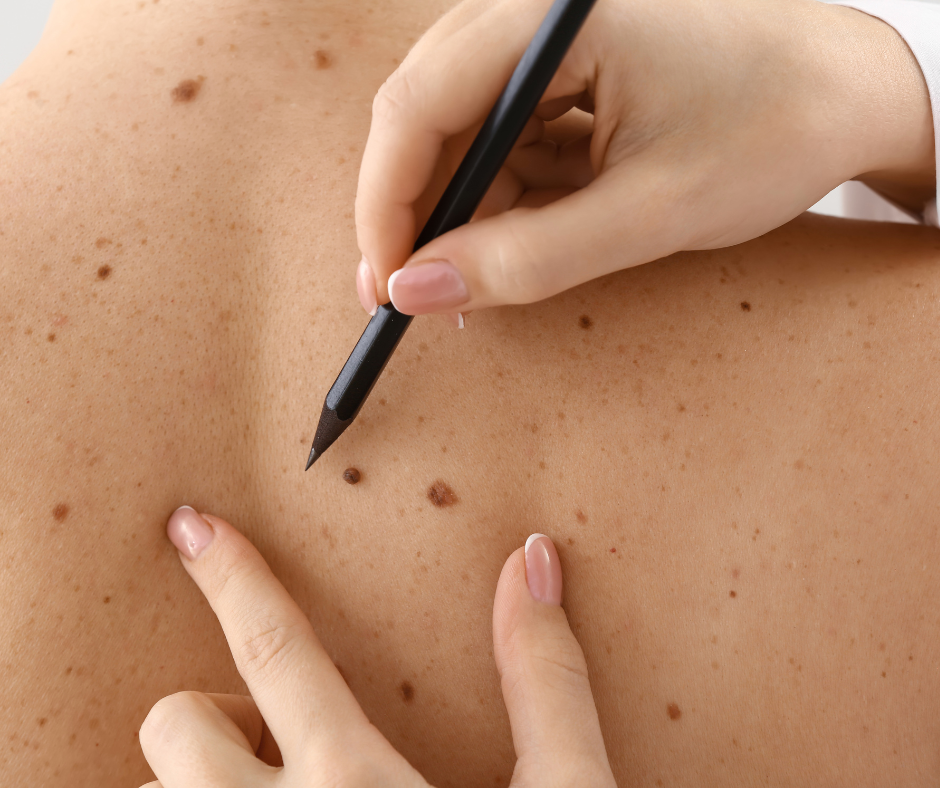 Skin Cancer | Service Page | LA Cancer Network